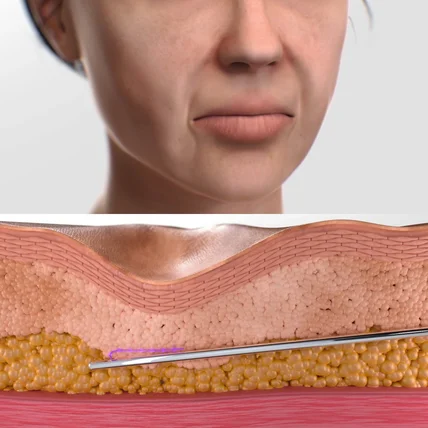 포트폴리오-[3D모델링] 실리프팅 시술 영상 3D