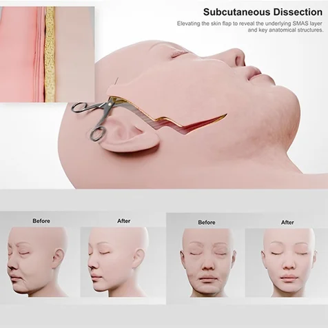 포트폴리오-[3D 의료영상] 성형외과 안면거상 수술 시뮬레이션