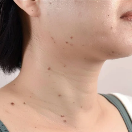 포트폴리오-쥐젖 제거 비포 애프터, ai 비포애프터, ai before&after