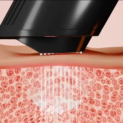 포트폴리오-[3D 영상] '인텐더' 레이저 뷰티 디바이스 소구포인트 3D GIF 영상