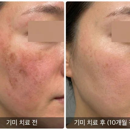 포트폴리오-ai 후기, ai 비포애프터, ai before & after, ai 피부 모델, ai 셀