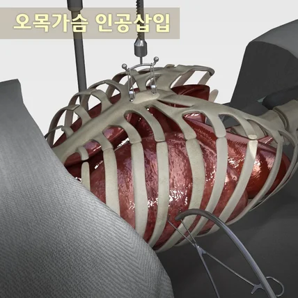 포트폴리오-[모션그래픽/3D모델링,사운드] 함몰된 오목가슴에 인공뼈 삽입 영상