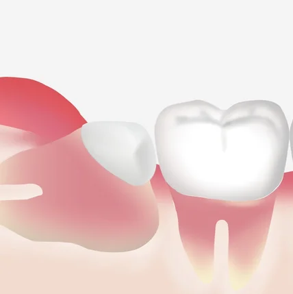 포트폴리오-치과치료과정일러스트